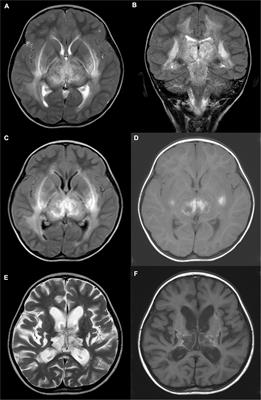 Clinical evaluation of acute necrotizing encephalopathy in children